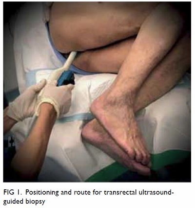 Prostate Biopsy